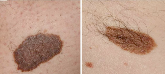 Šta su zapravo mladeži i zašto ponekad rastu dlake iz njih?