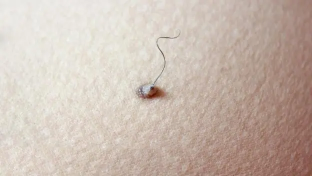 Šta su zapravo mladeži i zašto ponekad rastu dlake iz njih?