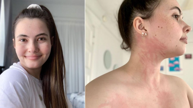 Alergična na zimu: Ispovijest žene koja ne smije izaći na hladnoću