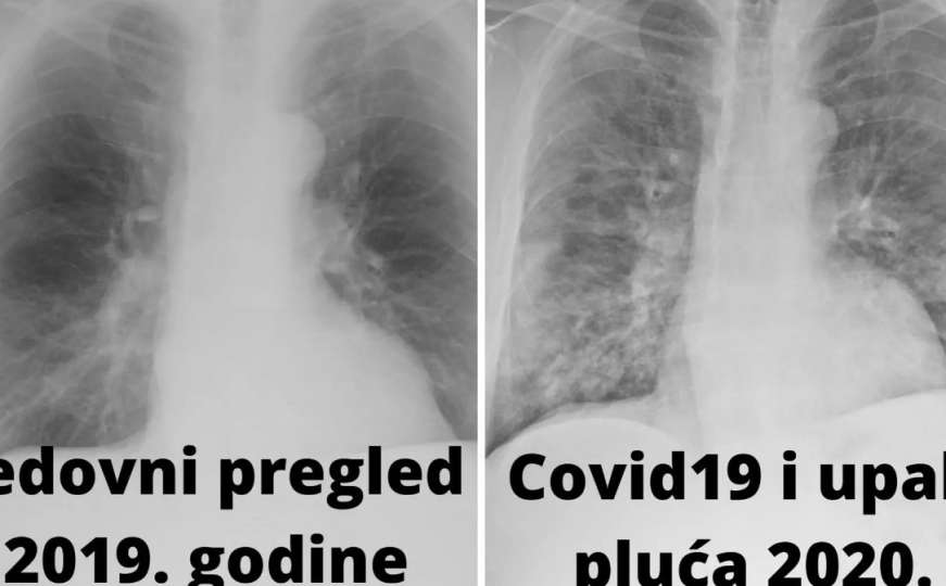 Šokantna upozorenja pulmologa: Zagađen zrak i danas razara pluća hiljada građana