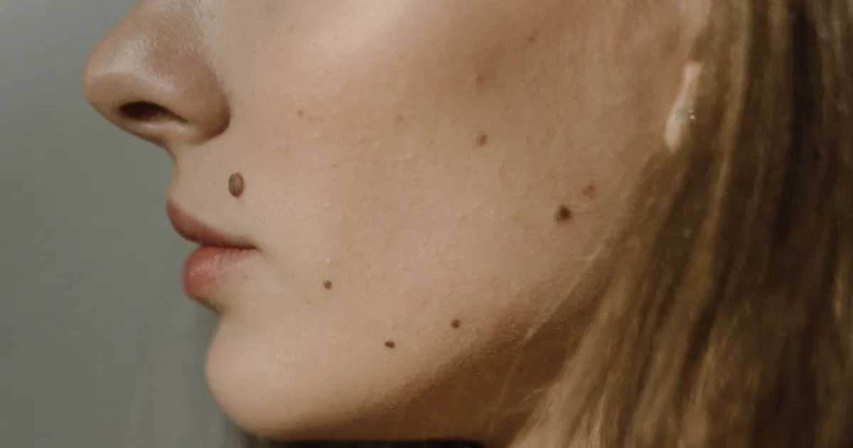 Šta su zapravo mladeži i zašto ponekad rastu dlake iz njih? Šta su zapravo mladeži i zašto ponekad rastu dlake iz njih?