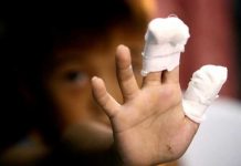 Prvi slučaj ove godine, ali bolan: Dijete teško povrijeđeno od petardi Prvi slučaj ove godine, ali bolan: Dijete teško povrijeđeno od petardi