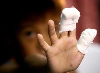 Prvi slučaj ove godine, ali bolan: Dijete teško povrijeđeno od petardi Prvi slučaj ove godine, ali bolan: Dijete teško povrijeđeno od petardi