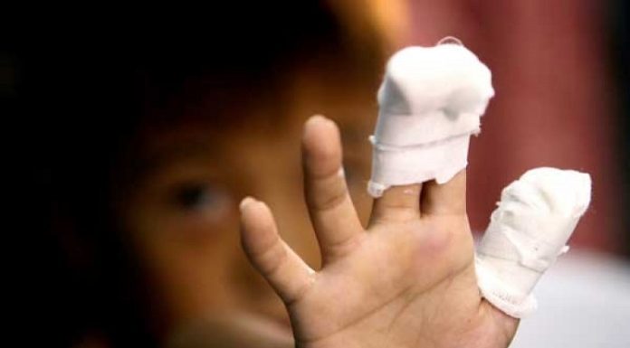 Prvi slučaj ove godine, ali bolan: Dijete teško povrijeđeno od petardi Prvi slučaj ove godine, ali bolan: Dijete teško povrijeđeno od petardi