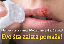 Herpes na usnama: Može li nestati za 24 sata? Evo šta zaista pomaže! Herpes na usnama: Može li nestati za 24 sata? Evo šta zaista pomaže!