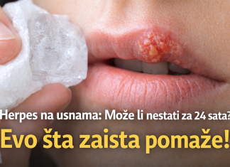 Herpes na usnama: Može li nestati za 24 sata? Evo šta zaista pomaže! Herpes na usnama: Može li nestati za 24 sata? Evo šta zaista pomaže!