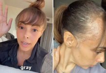 “Ovo se nikad nije desilo” – šok nakon transplantacije kose u Los Angelesu