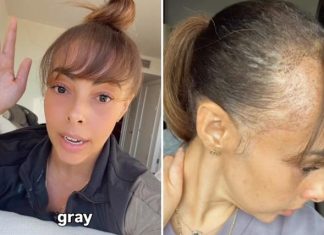 “Ovo se nikad nije desilo” – šok nakon transplantacije kose u Los Angelesu