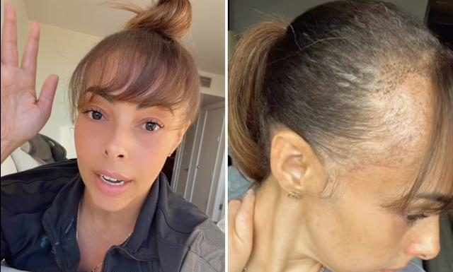 “Ovo se nikad nije desilo” – šok nakon transplantacije kose u Los Angelesu