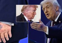 Novi zdravstveni izvještaj o Trumpu: Ljekari otkrili zbog čega ima modrice i otečene noge
