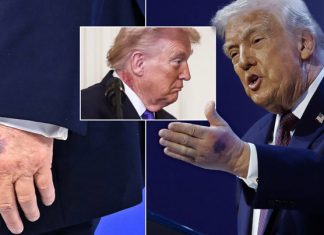 Novi zdravstveni izvještaj o Trumpu: Ljekari otkrili zbog čega ima modrice i otečene noge
