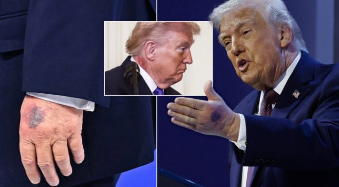 Novi zdravstveni izvještaj o Trumpu: Ljekari otkrili zbog čega ima modrice i otečene noge