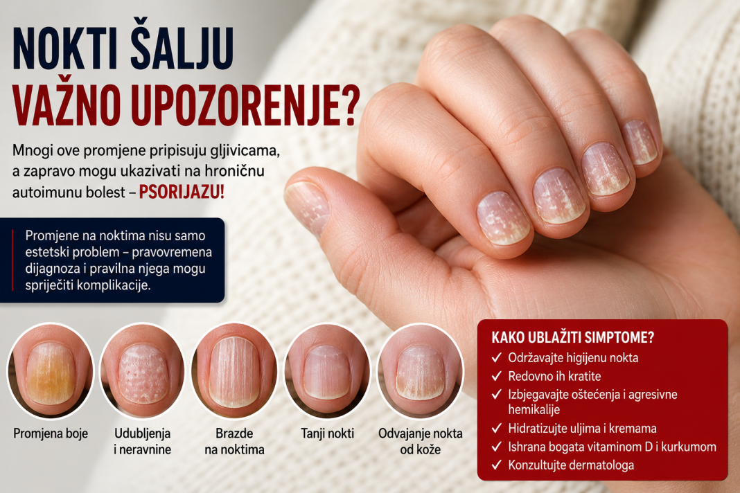 Nokti vam mijenjaju boju i pucaju? To možda nije gljivica, već znak hronične bolesti