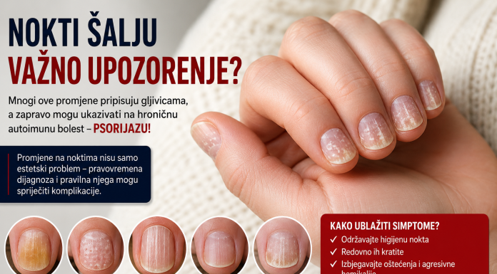 Nokti vam mijenjaju boju i pucaju? To možda nije gljivica, već znak hronične bolesti Nokti vam mijenjaju boju i pucaju? To možda nije gljivica, već znak hronične bolesti