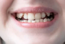 KRIVI ZUBI NISU JEDINI ZNAK! Ortodont otkriva šta još može ukazivati da je djetetu potreban aparatić KRIVI ZUBI NISU JEDINI ZNAK! Ortodont otkriva šta još može ukazivati da je djetetu potreban aparatić