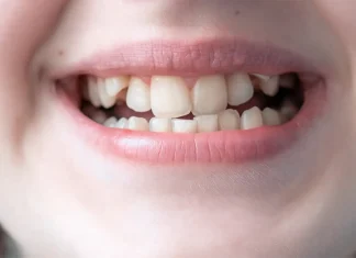 KRIVI ZUBI NISU JEDINI ZNAK! Ortodont otkriva šta još može ukazivati da je djetetu potreban aparatić KRIVI ZUBI NISU JEDINI ZNAK! Ortodont otkriva šta još može ukazivati da je djetetu potreban aparatić